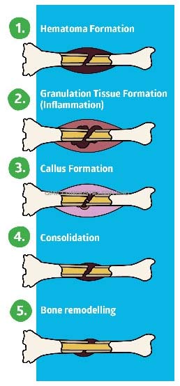 5-stages-bone-fracture-healing